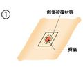 褥瘡に対して通常の処置をします。