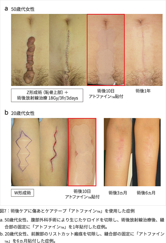 術後にテープを貼って意味がある 学会記録 学術情報 医療関係者向け ニチバン株式会社 製品情報サイト